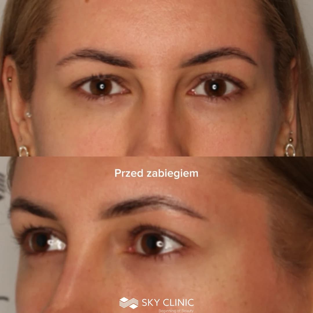 Blefaroplastyka - przed zabiegiem, gojenie u Pacjentki SkyClinic