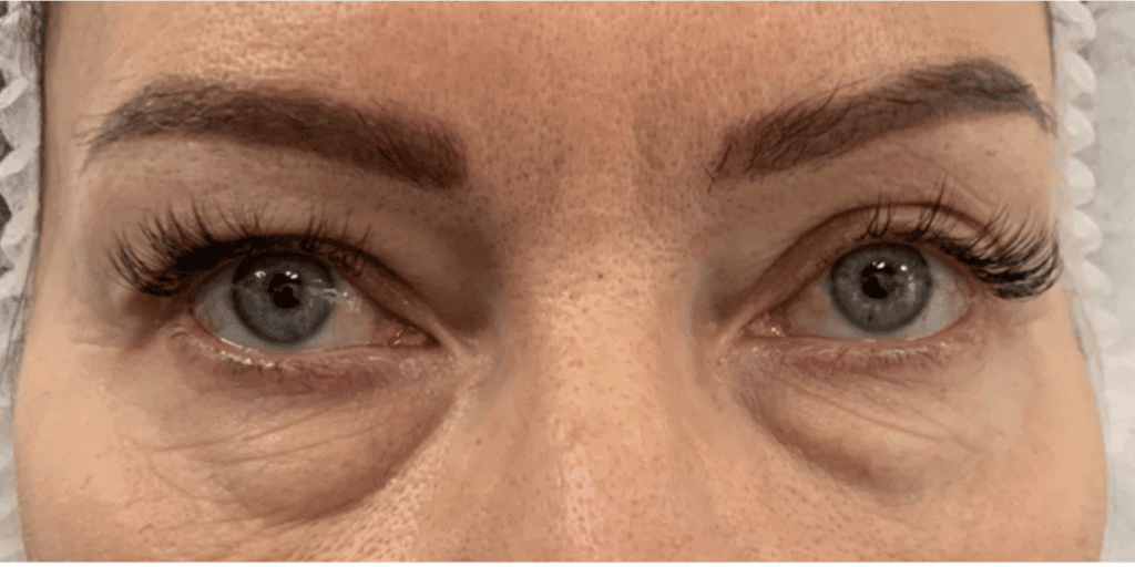 Stan przed zabiegiem blefaroplastyki, pacjentka 1 - SkyClinic