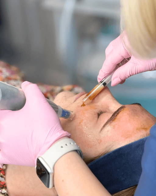 Zabieg mezoterapii mikroigłowej Dermapen w klinice SkyClinic