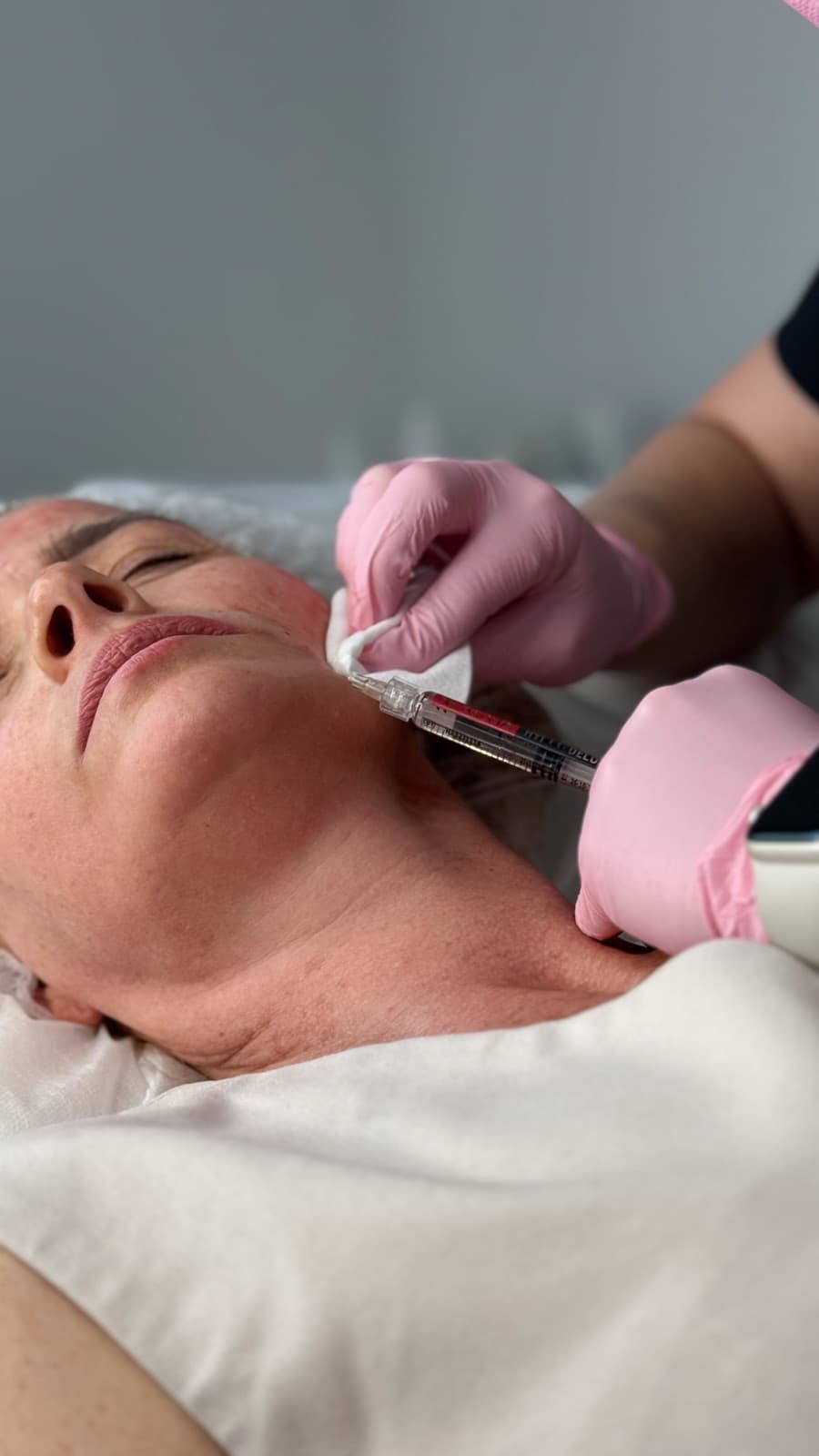 Podanie koktajlu mezoterapeutycznego cienką igłą w skórę policzka