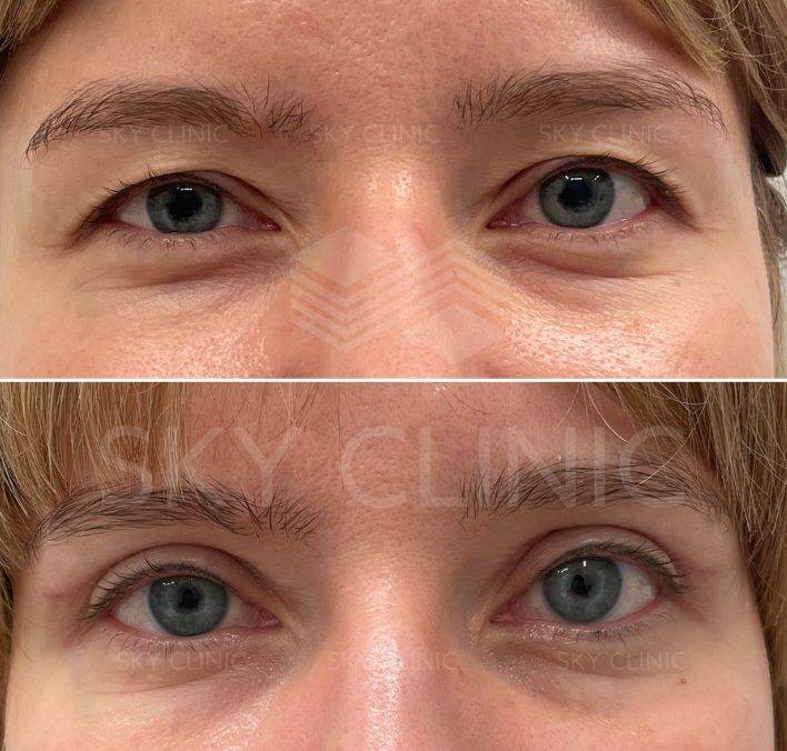 blefaroplastyka